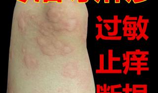 治疗慢性荨麻疹的药 治疗慢性荨麻疹的药